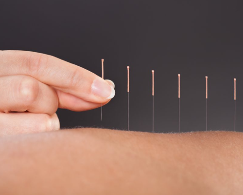 Dry Needling Therapy Pinpoint solution to pain