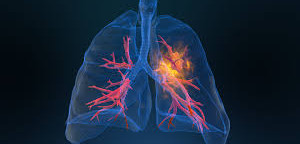 Lung Cancer Symptoms and Treatments